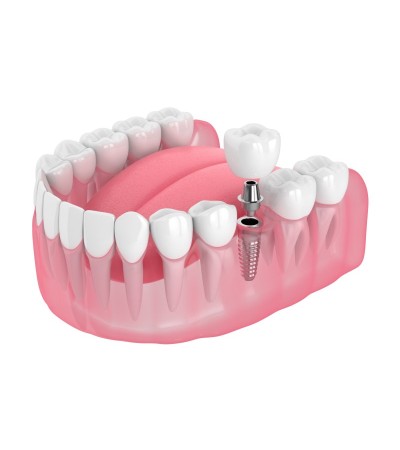 Dental Implants Treatment in Ameenpur Hyderabad