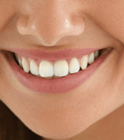 Smile Designing Treatment